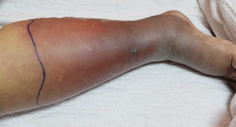 TROMBOSE - Aumenta com o uso de anticoncepcionais?